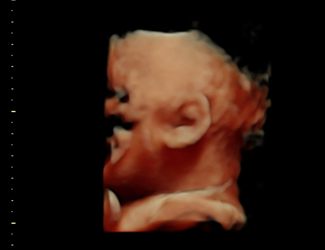 3D ultrasound image at 31 weeks
